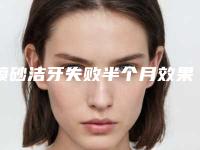 喷砂洁牙失败半个月效果对比图